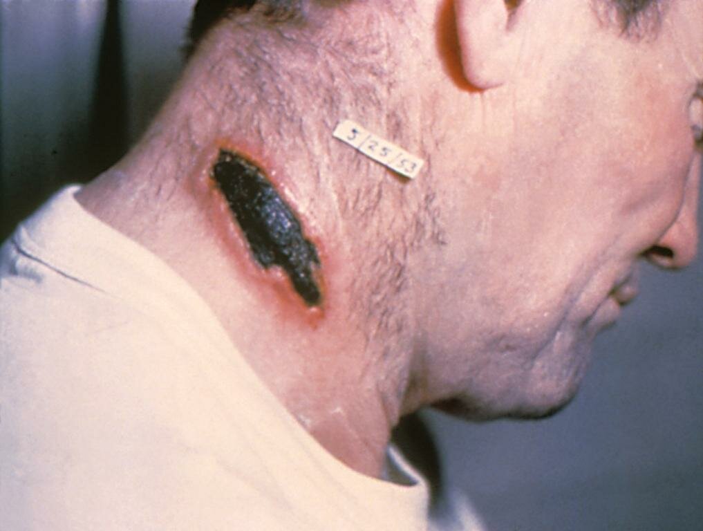 Cutaneous_anthrax_lesion_on_the_neck._PHIL_1934_lores