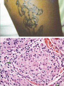 Tatto and sarcoidosis