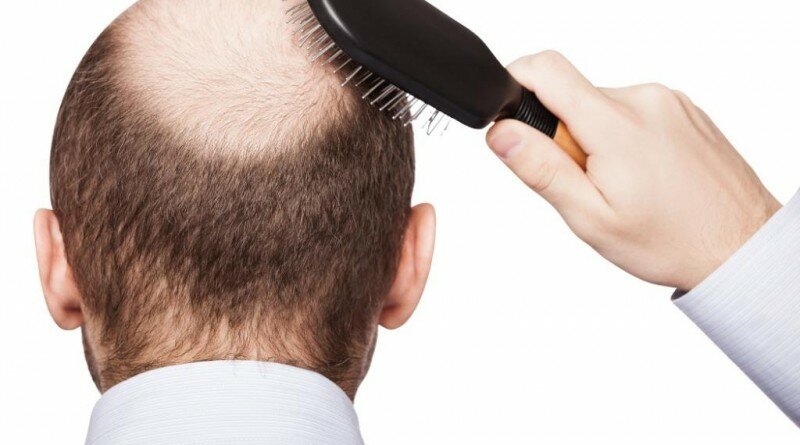 hairtransplant